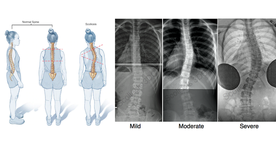 Radiation-free Spine Reconstruction and Posture Analysis Techniques with 3D Imaging